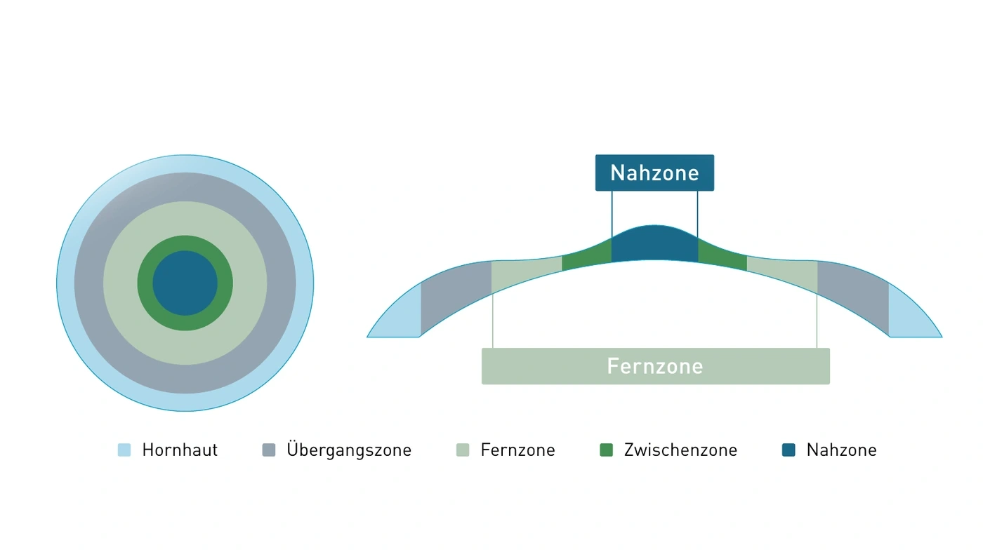 Schema des multifokalen Abtragsprofils mit Nahzone in der Mitte, Zwischenzone, Fernzone und Übergangszone